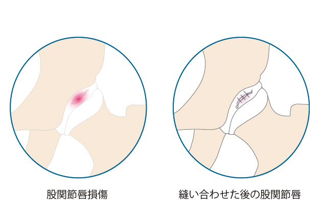 股関節鏡視下股関節唇形成術