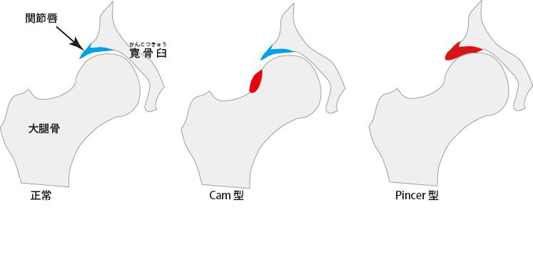 大腿骨寛骨臼インピンジメント(FAI)の股関節鏡手術